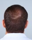 After Hair Transplant&nbsp;Midscalp